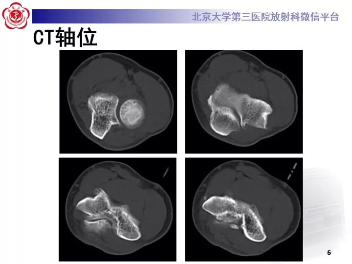 【病例】肘管综合征1例MR影像表现