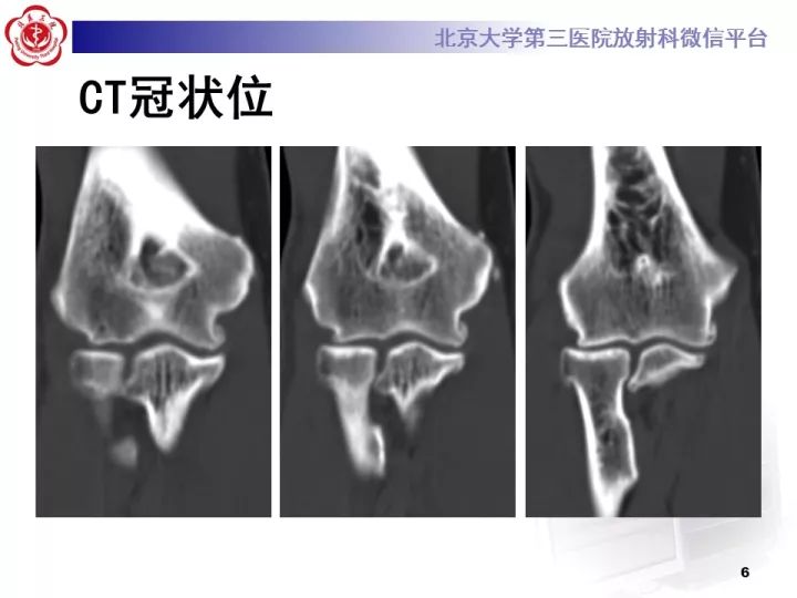 【病例】肘管综合征1例MR影像表现