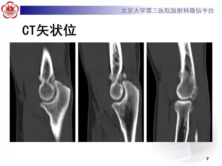 【病例】肘管综合征1例MR影像表现