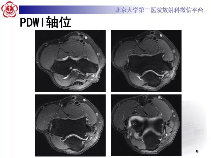 【病例】肘管综合征1例MR影像表现