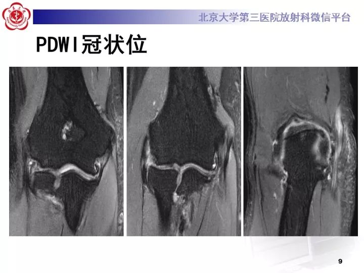 【病例】肘管综合征1例MR影像表现