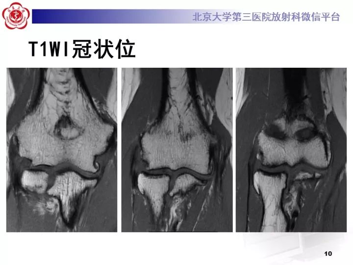 【病例】肘管综合征1例MR影像表现