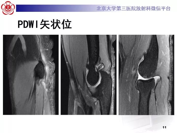 【病例】肘管综合征1例MR影像表现