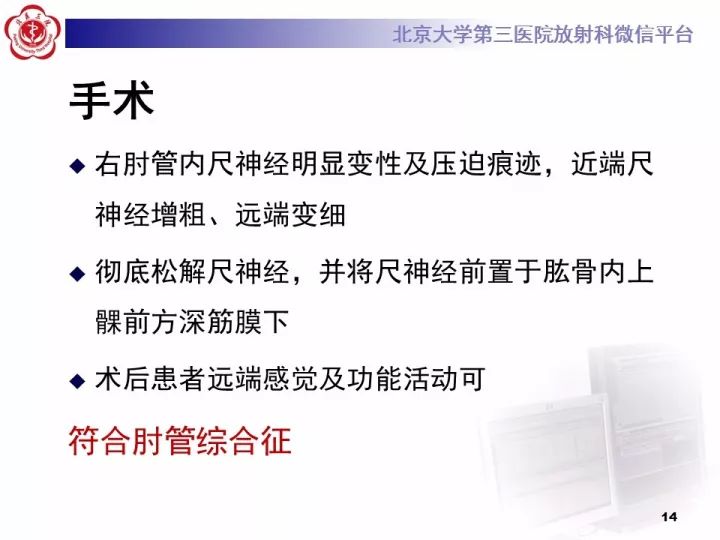 【病例】肘管综合征1例MR影像表现