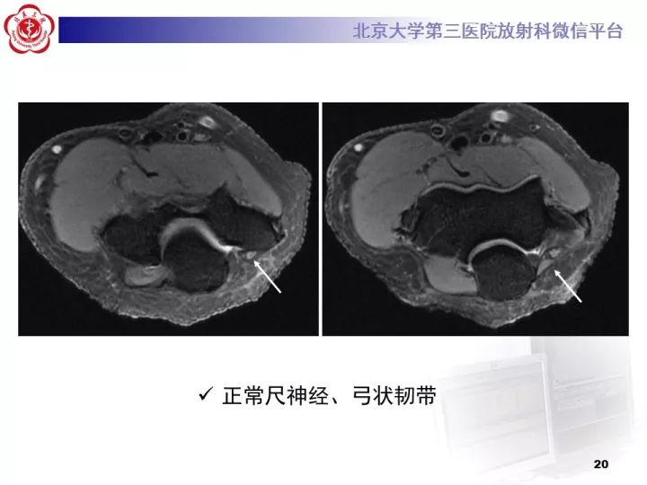 【病例】肘管综合征1例MR影像表现