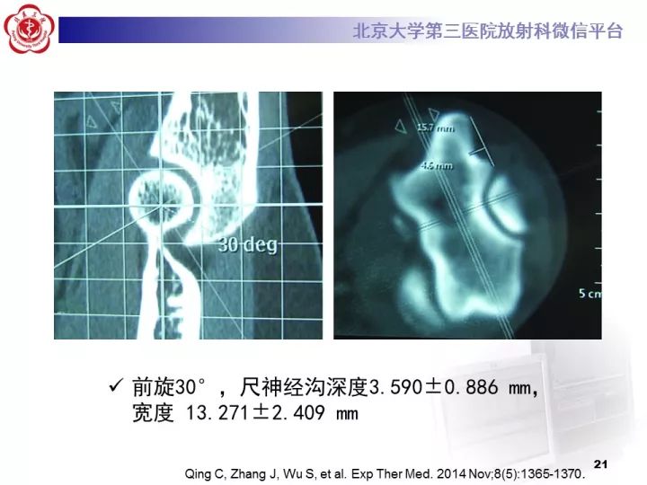 【病例】肘管综合征1例MR影像表现