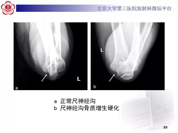 【病例】肘管综合征1例MR影像表现