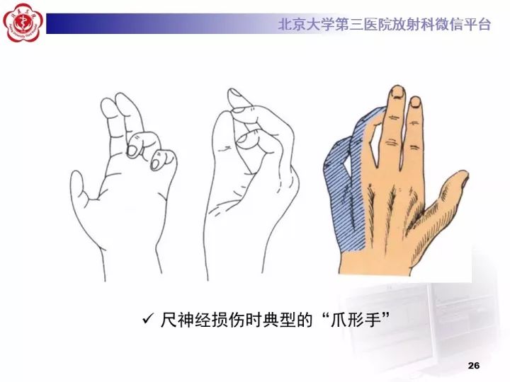 【病例】肘管综合征1例MR影像表现