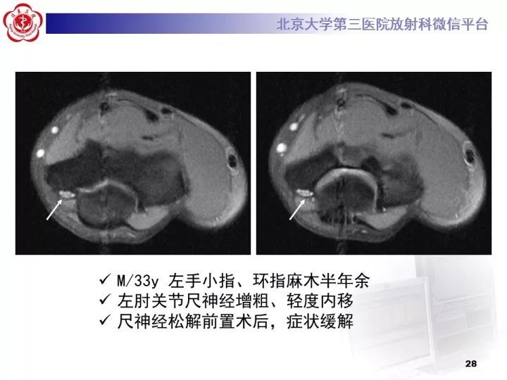 【病例】肘管综合征1例MR影像表现