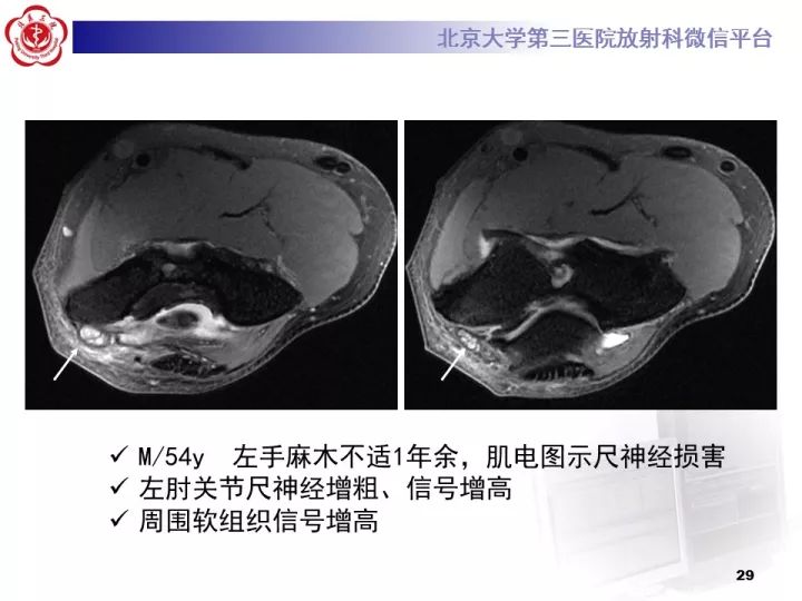 【病例】肘管综合征1例MR影像表现