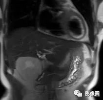 【病例】不典型肝脏海绵状血管瘤1例CT 【病例】不典型肝脏海绵状血管瘤1例CT