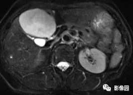 【病例】不典型肝脏海绵状血管瘤1例CT 【病例】不典型肝脏海绵状血管瘤1例CT