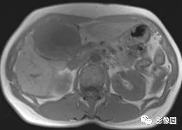 【病例】不典型肝脏海绵状血管瘤1例CT 【病例】不典型肝脏海绵状血管瘤1例CT