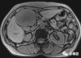 【病例】不典型肝脏海绵状血管瘤1例CT 【病例】不典型肝脏海绵状血管瘤1例CT