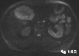 【病例】不典型肝脏海绵状血管瘤1例CT 【病例】不典型肝脏海绵状血管瘤1例CT