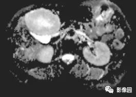 【病例】不典型肝脏海绵状血管瘤1例CT 【病例】不典型肝脏海绵状血管瘤1例CT