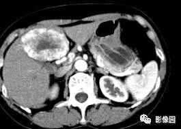 【病例】不典型肝脏海绵状血管瘤1例CT 【病例】不典型肝脏海绵状血管瘤1例CT