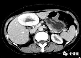 【病例】不典型肝脏海绵状血管瘤1例CT