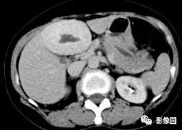 【病例】不典型肝脏海绵状血管瘤1例CT 【病例】不典型肝脏海绵状血管瘤1例CT