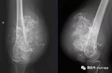 【病例】软骨肉瘤1例X线及MR 【病例】软骨肉瘤1例X线及MR