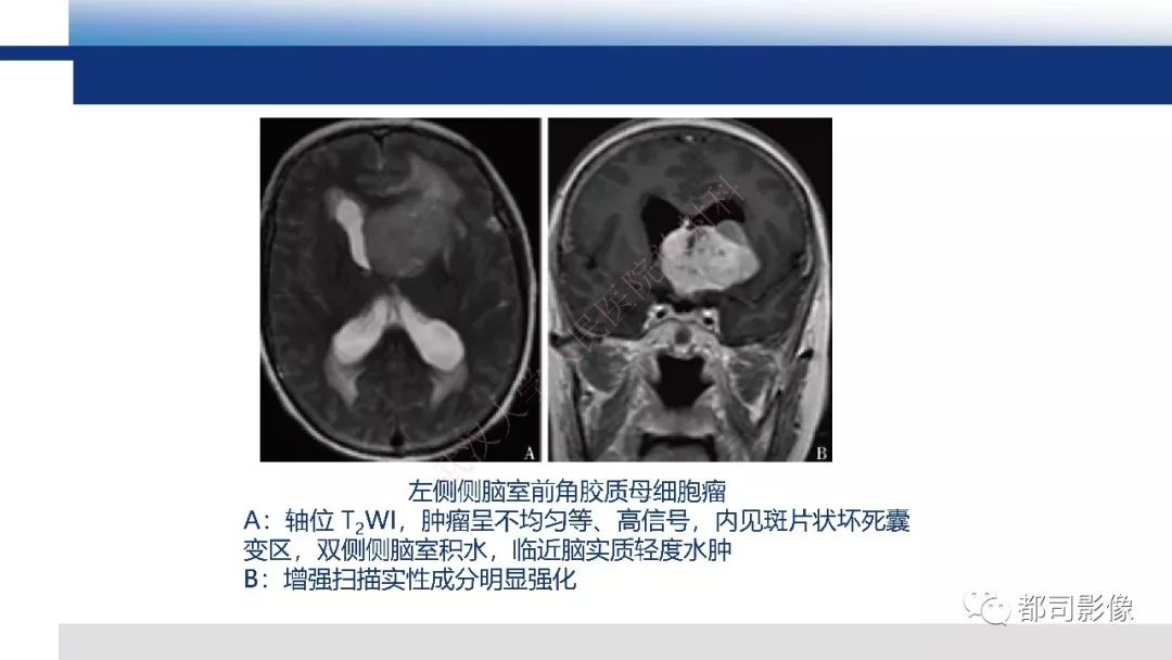 【病例】巨细胞胶质母细胞瘤1例CT及MR影像诊断