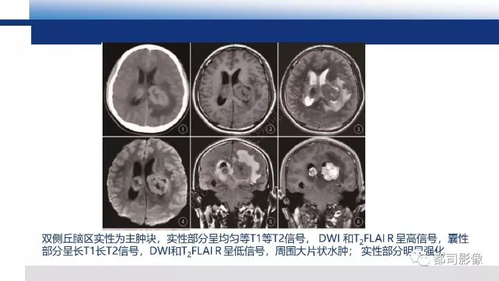 【病例】巨细胞胶质母细胞瘤1例CT及MR影像诊断