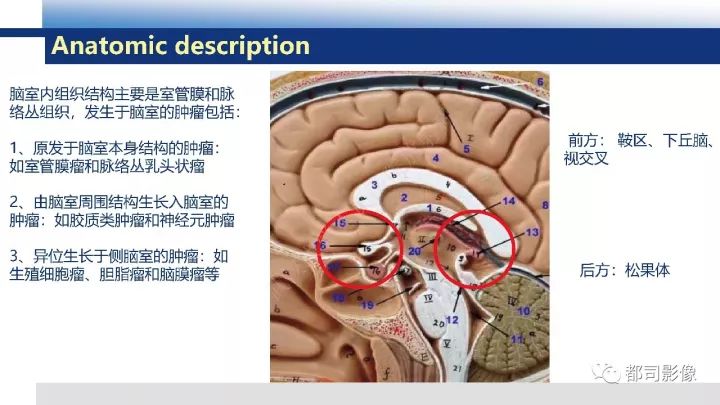 【病例】巨细胞胶质母细胞瘤1例CT及MR影像诊断