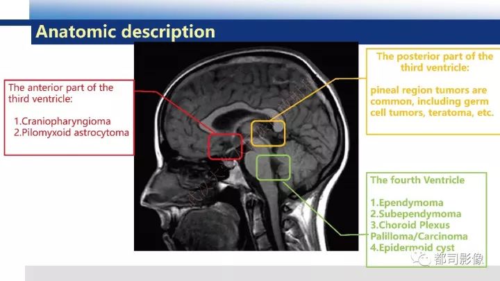 【病例】巨细胞胶质母细胞瘤1例CT及MR影像诊断