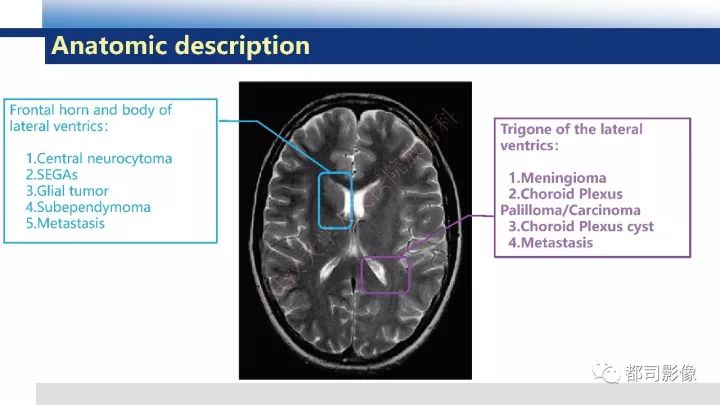 【病例】巨细胞胶质母细胞瘤1例CT及MR影像诊断