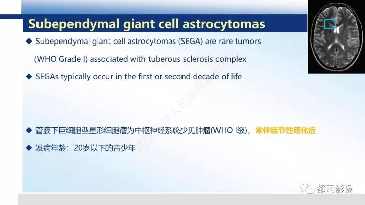 【病例】巨细胞胶质母细胞瘤1例CT及MR影像诊断