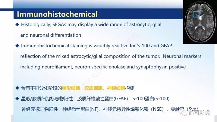 【病例】巨细胞胶质母细胞瘤1例CT及MR影像诊断