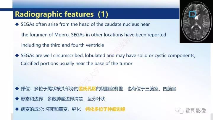 【病例】巨细胞胶质母细胞瘤1例CT及MR影像诊断