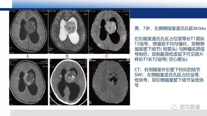 【病例】巨细胞胶质母细胞瘤1例CT及MR影像诊断
