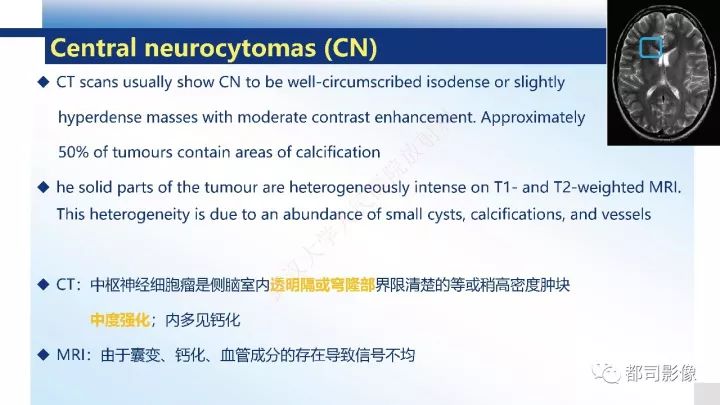 【病例】巨细胞胶质母细胞瘤1例CT及MR影像诊断