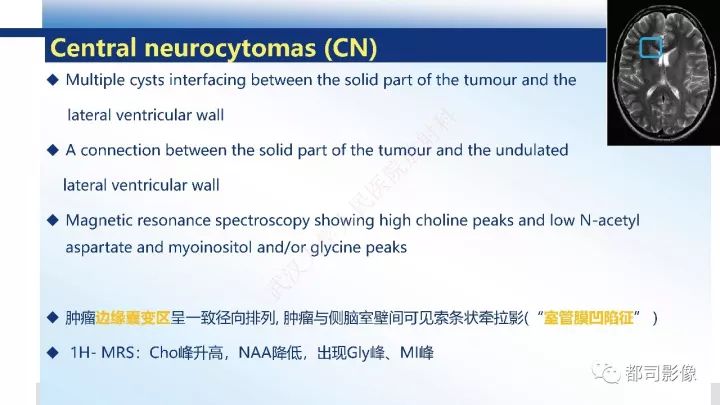 【病例】巨细胞胶质母细胞瘤1例CT及MR影像诊断