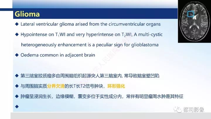 【病例】巨细胞胶质母细胞瘤1例CT及MR影像诊断