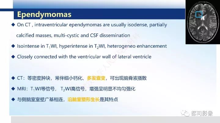 【病例】巨细胞胶质母细胞瘤1例CT及MR影像诊断
