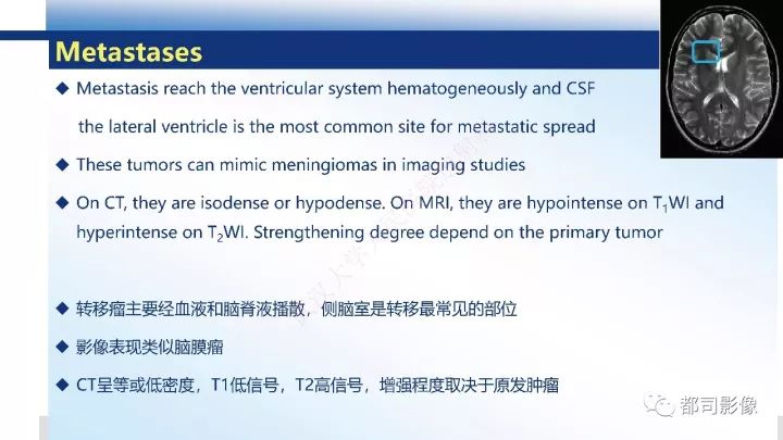 【病例】巨细胞胶质母细胞瘤1例CT及MR影像诊断