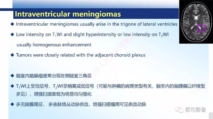 【病例】巨细胞胶质母细胞瘤1例CT及MR影像诊断