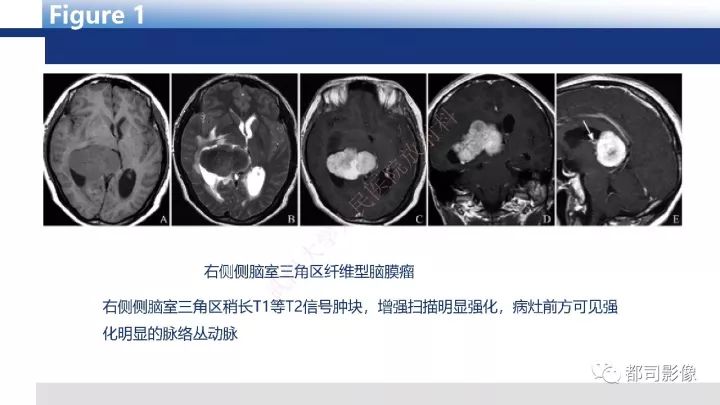 【病例】巨细胞胶质母细胞瘤1例CT及MR影像诊断