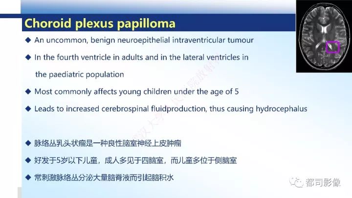 【病例】巨细胞胶质母细胞瘤1例CT及MR影像诊断