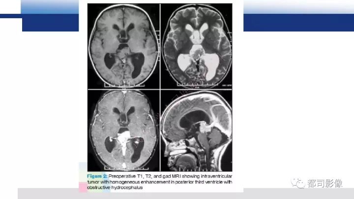 【病例】巨细胞胶质母细胞瘤1例CT及MR影像诊断