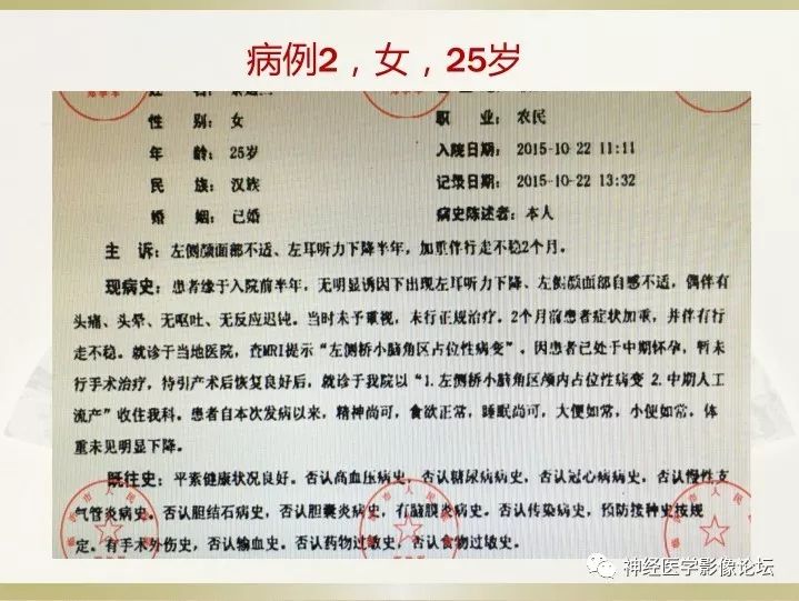 【病例】左侧CPA区肠源性囊肿1例CT及MR影像表现