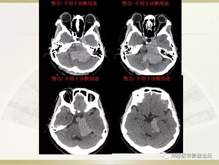 【病例】左侧CPA区肠源性囊肿1例CT及MR影像表现