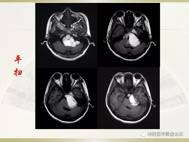 【病例】左侧CPA区肠源性囊肿1例CT及MR影像表现