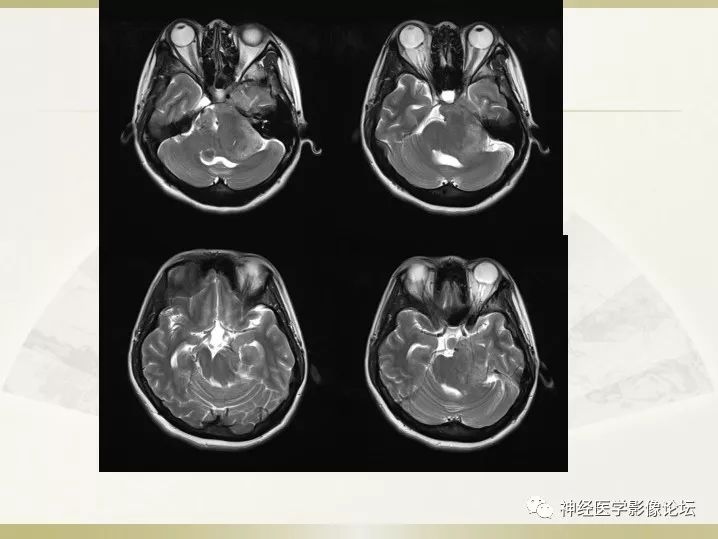 【病例】左侧CPA区肠源性囊肿1例CT及MR影像表现