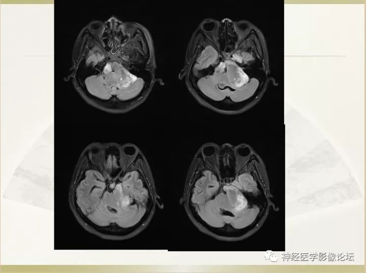 【病例】左侧CPA区肠源性囊肿1例CT及MR影像表现