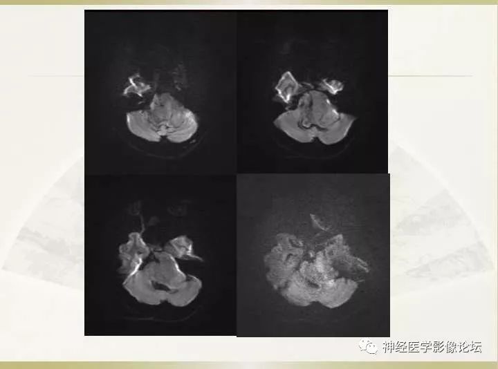 【病例】左侧CPA区肠源性囊肿1例CT及MR影像表现
