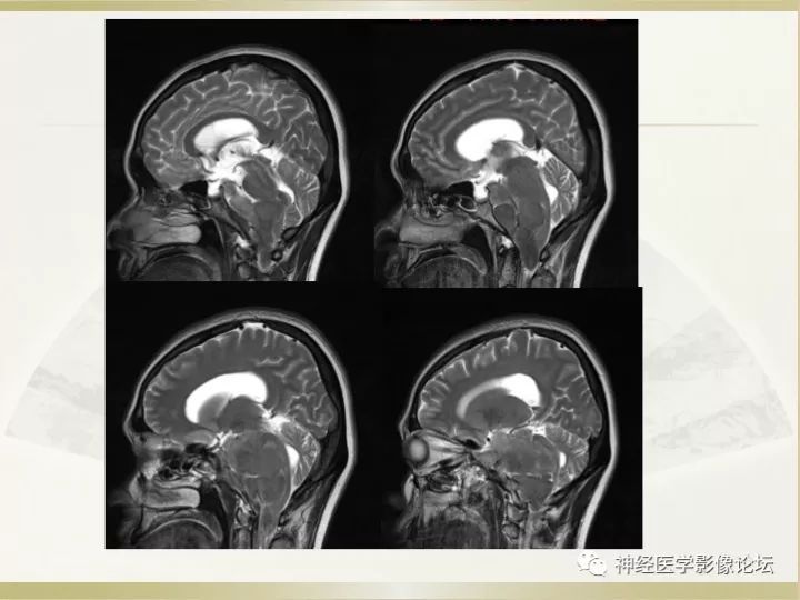 【病例】左侧CPA区肠源性囊肿1例CT及MR影像表现
