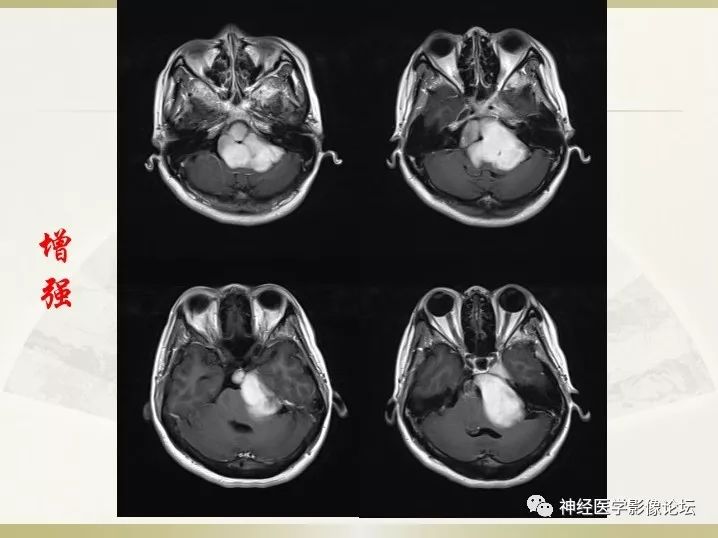 【病例】左侧CPA区肠源性囊肿1例CT及MR影像表现